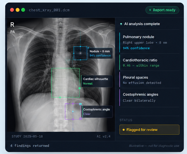 AI radiology analysis interface showing chest X-ray with annotated findings